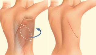 Reconstrucción mamaria mediante colgajo dorsal ancho