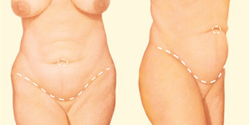 Antes de una abdominoplastia: la incisión se coloca sobre el área púbica para permitir extirpar el exceso de piel y grasa