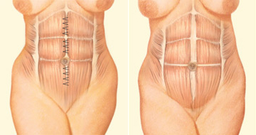 Antes de la abdominoplastia: musculatura de la pared abdominal. | La musculatura y la pared abdominal son aproximados para conseguir una cintua más estrecha y larga.