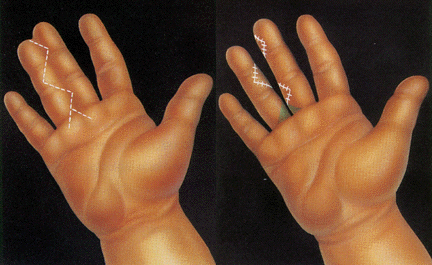 Sindactilia típica (dos dedos están fusionados). El cirujano usa incisiones en zig-zag para separar los dedos, creando colgajos cutáneos triangulares. | Los injertos de piel se usan para cubrir las a´reas sombreadas en la base de los de dedos.