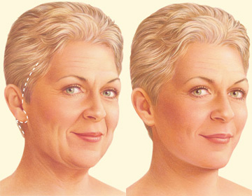 Las incisiones suelen colocarse en pelo, delante de la oreja y detrás de esta. El tejido de la cara y del cuello y la musculatura son separados para conseguir un estiramiento adecuado. Resultado