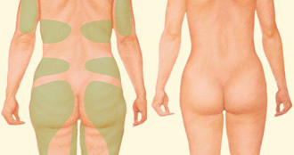 Las mujeres pueden someterse a una liposucción en la región de la papada, caderas, muslos, abdomen, debajo de los brazos y alrededor de la mama. | Resultado tras una liposucción.