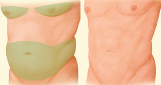 Los hombres pueden someterse a una liposucción en la papada y alrededor de las caderas, también se emplea para reducier el pecho aumentado, condición conocida como ginecomastia. | Resultado tras una liposucción.