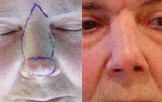 Extirpaciñon de un tumor en la punta nasal y recontrucción mediante colgajo